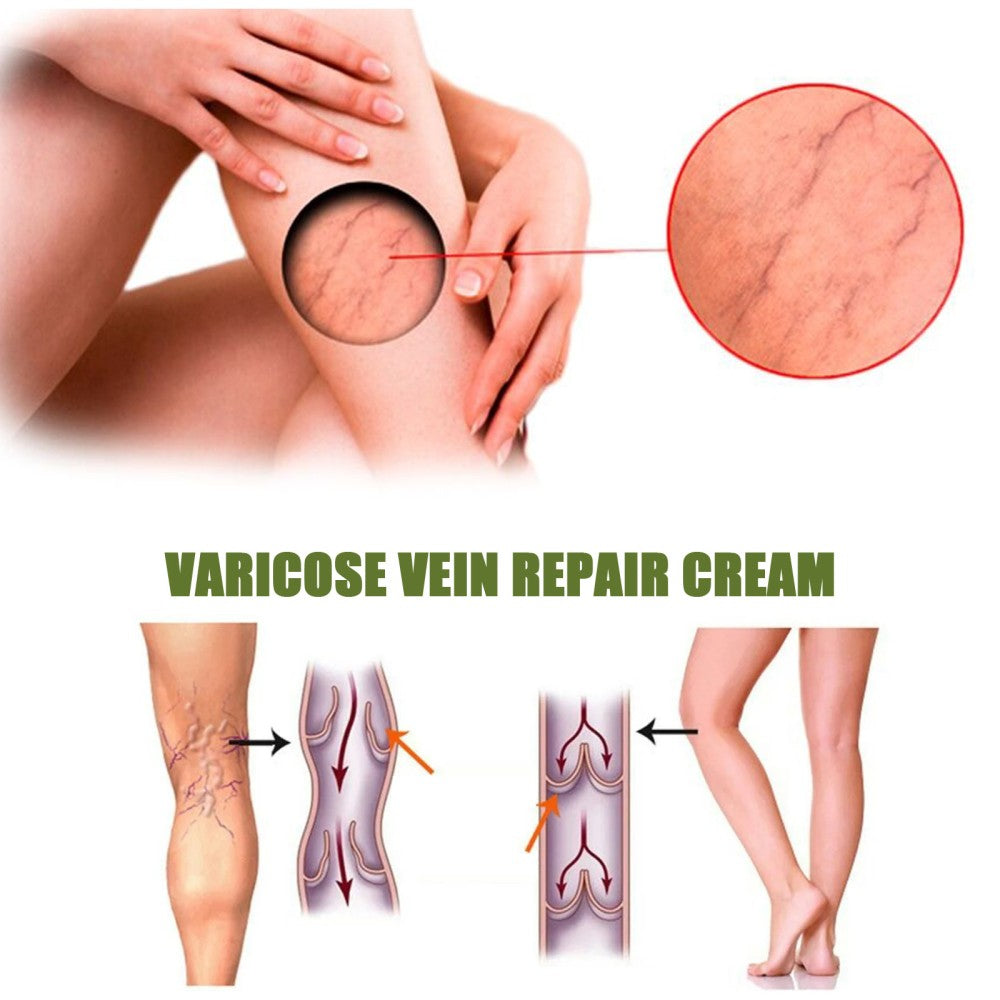 Seurico™ Varicose Veins Spray