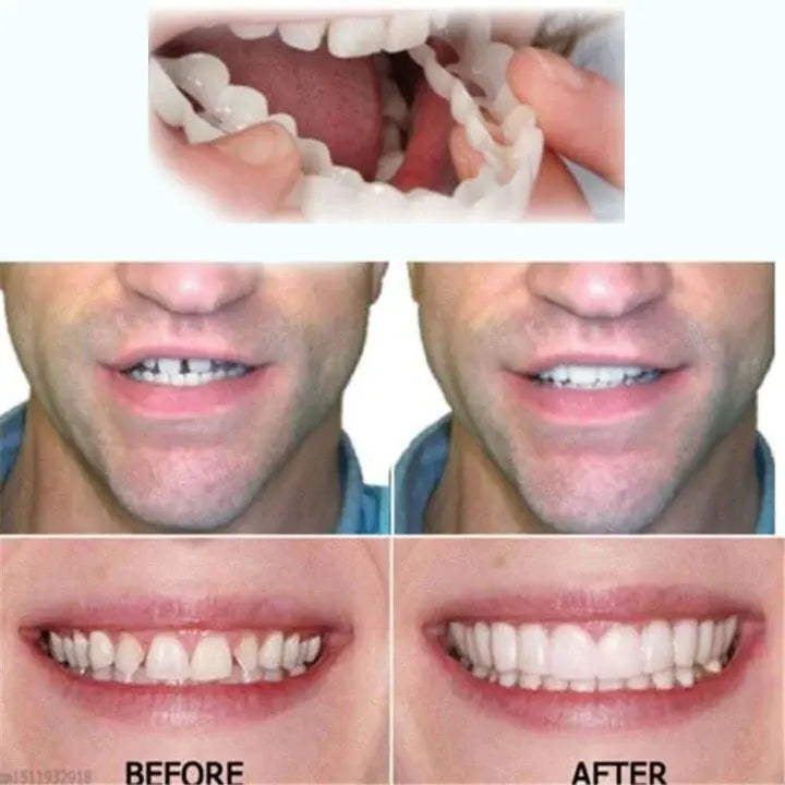 💝Last day discount-75%Off💝Latest👨⚕Adjustable Snap-On Dentures😁