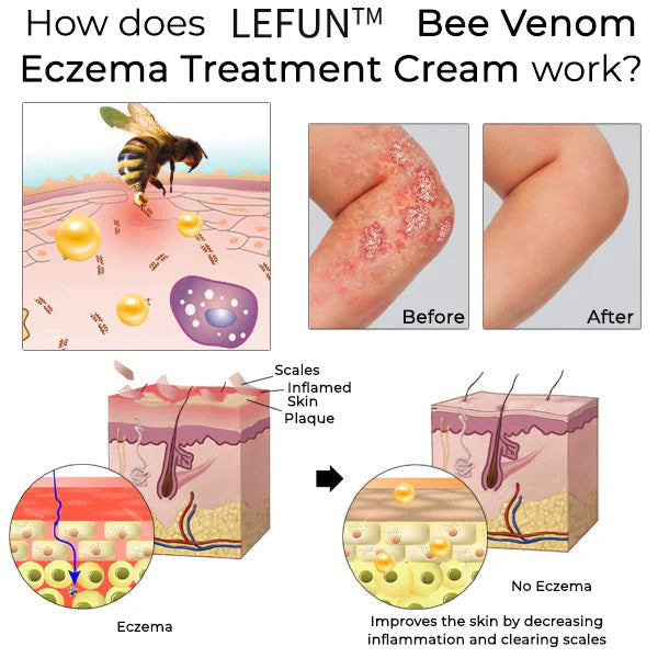 （🍀 Last Day 80% Off🍀）AQA™ Bee Venom  Therapy Cream