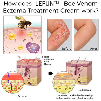 （🍀 Last Day 80% Off🍀）AQA™ Bee Venom  Therapy Cream