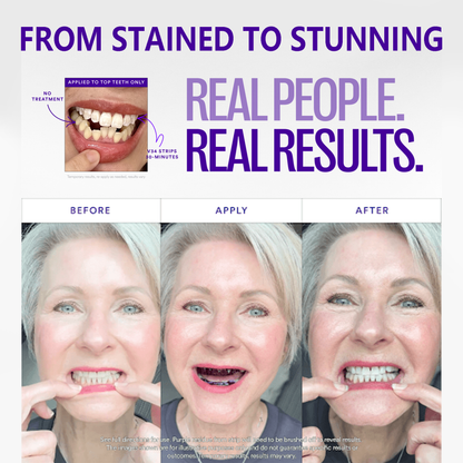 🦷V36 Whitening Strips – Professional Teeth Whitening at Home