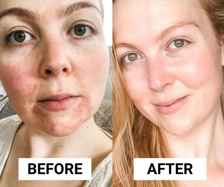 Seurico™  Dermatitis Repair Cream!【Skin color correction】