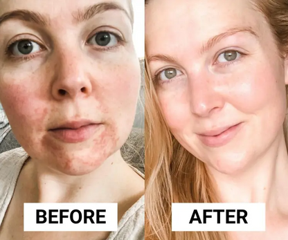 Seurico™  Dermatitis Repair Cream!【Skin color correction】