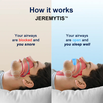 🔥JEREMYTIS™  Professional intelligent anti-snoring device