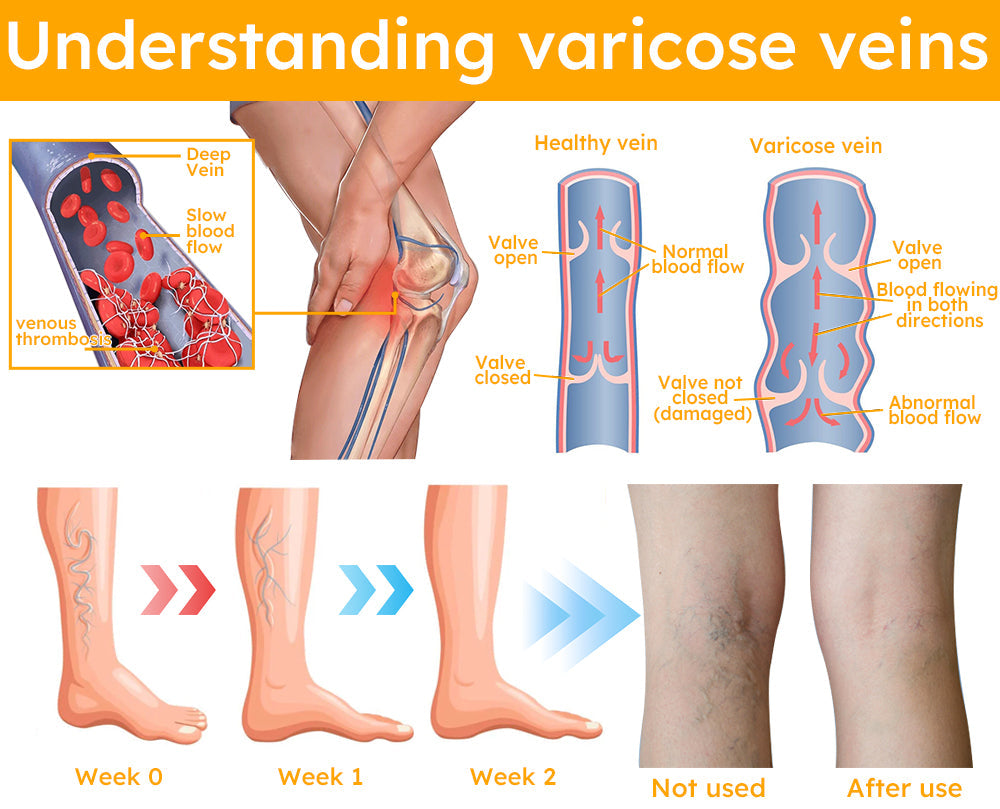 Seurico™ Bee  Venom Varicose Veins Spray
