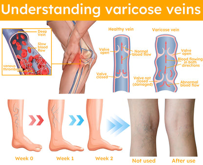 Seurico™ Bee  Venom Varicose Veins Spray