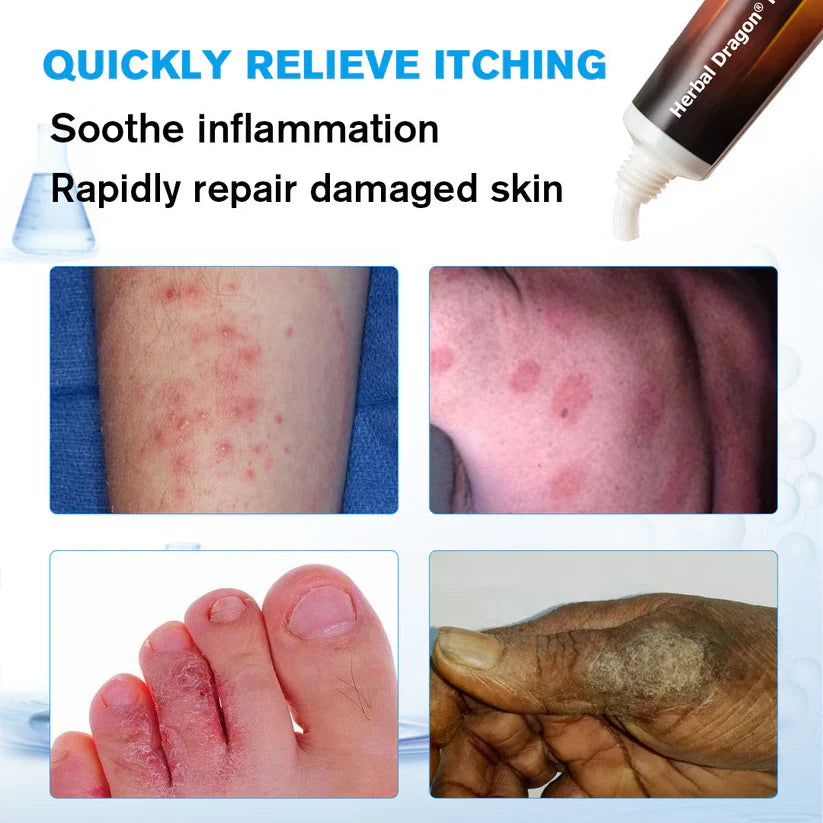 Herbal Dragon® Ringworm Removal Cream