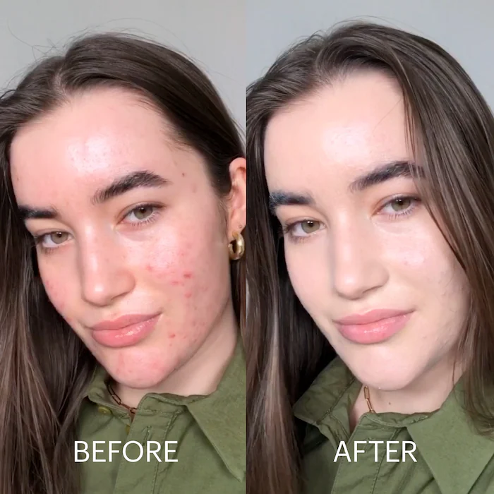 Seurico™  Dermatitis Repair Cream!【Skin color correction】