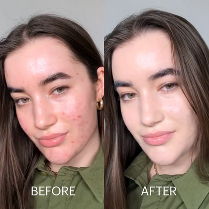 Seurico™  Dermatitis Repair Cream!【Skin color correction】