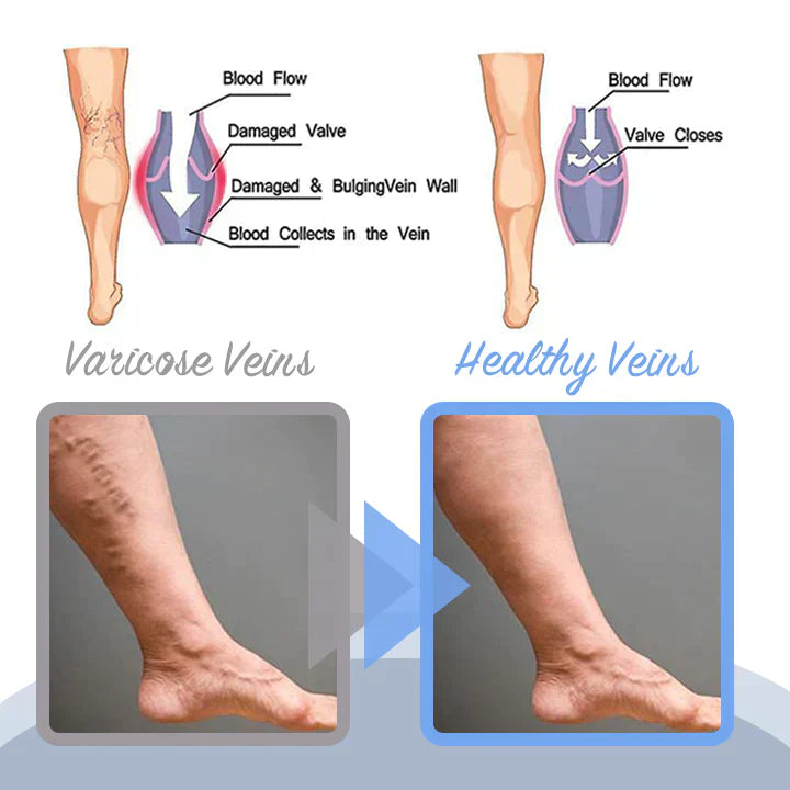 Seurico™ Varicose Veins Spray