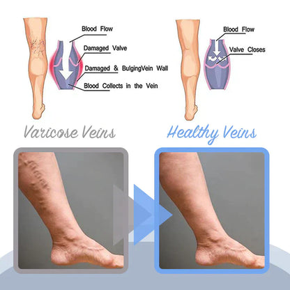 Seurico™ Varicose Veins Spray