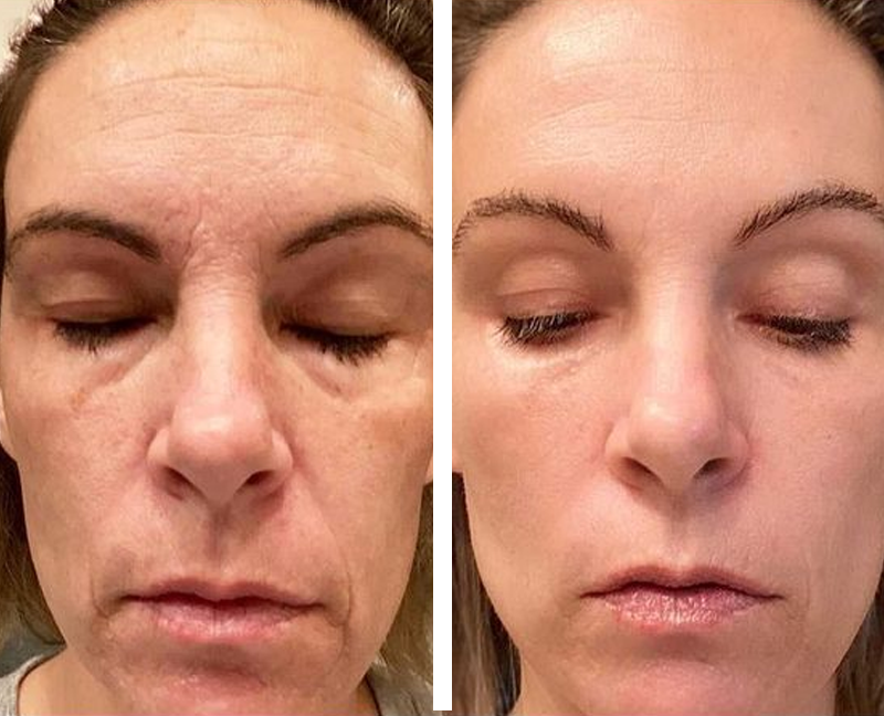 Flysmus™ Skip the Line Instant Wrinkle Eraser