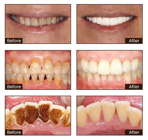 ⏰[Official Brand Store 24-Hours Promotion]" JEREMYTIS™ Ultra Whitening Mint Toothpaste✨"