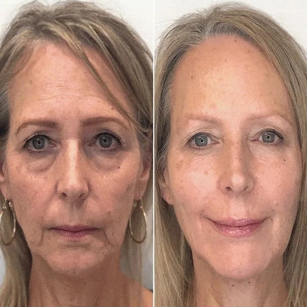 Last Day Promotion 49% OFF - 🔥Seurico™ Face Serum