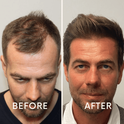 🔥Seurico™ Patented🔥 Red Light Therapy Hair Growth Cap