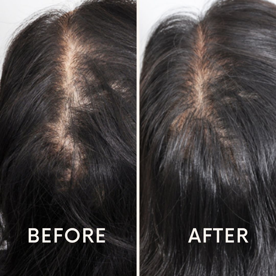 🔥Seurico™ Patented🔥 Red Light Therapy Hair Growth Cap