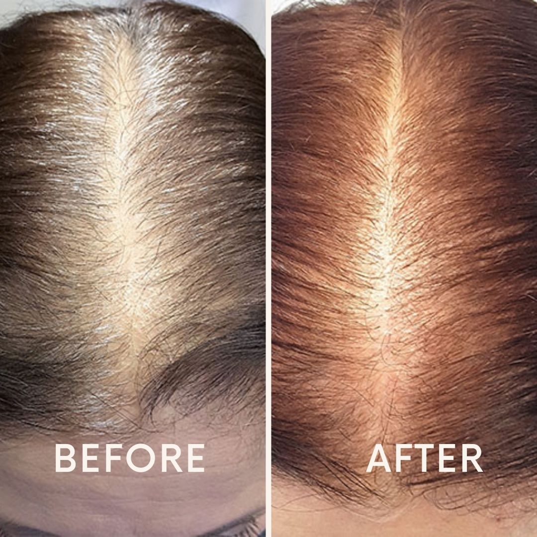 🔥Seurico™ Patented🔥 Red Light Therapy Hair Growth Cap