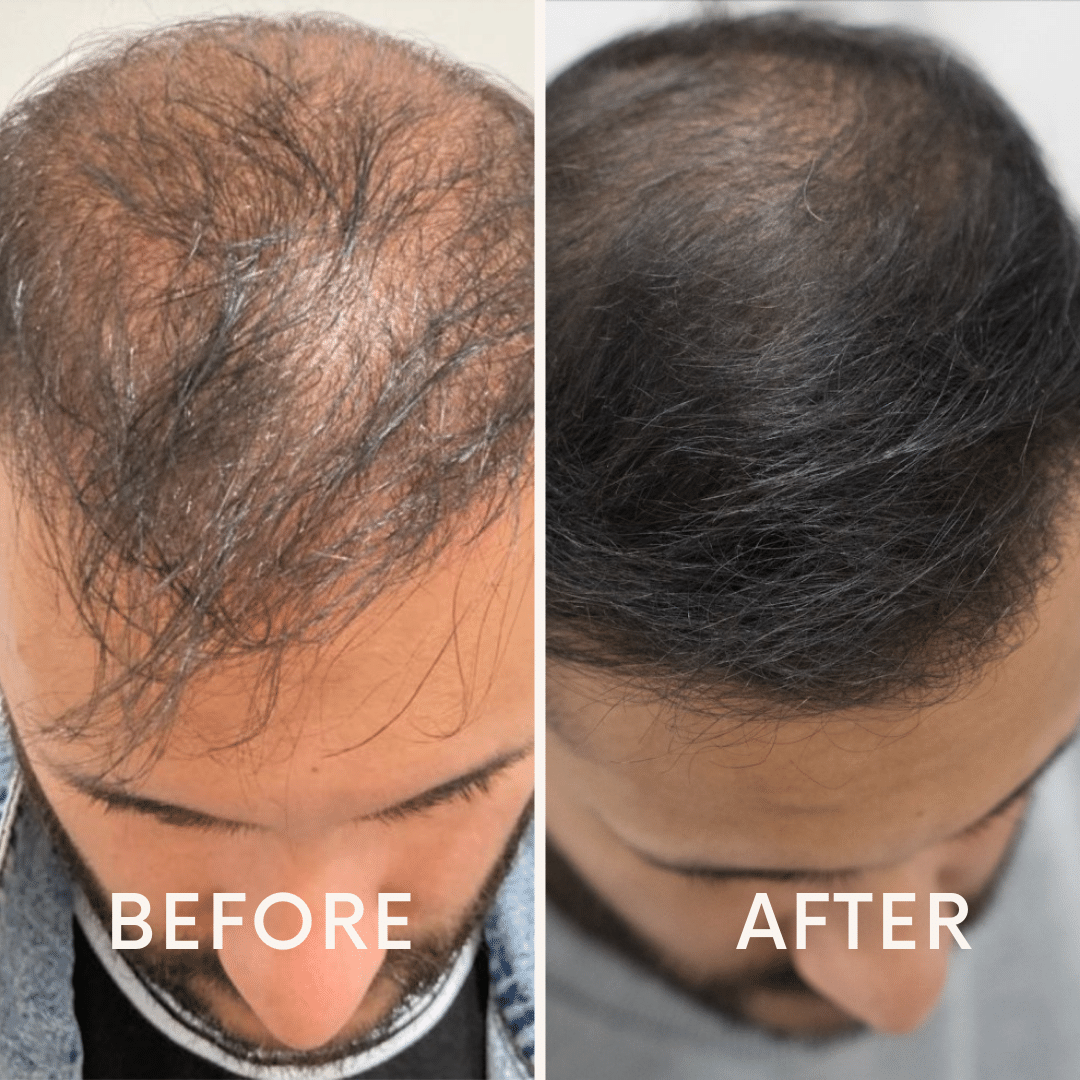 🔥Seurico™ Patented🔥 Red Light Therapy Hair Growth Cap