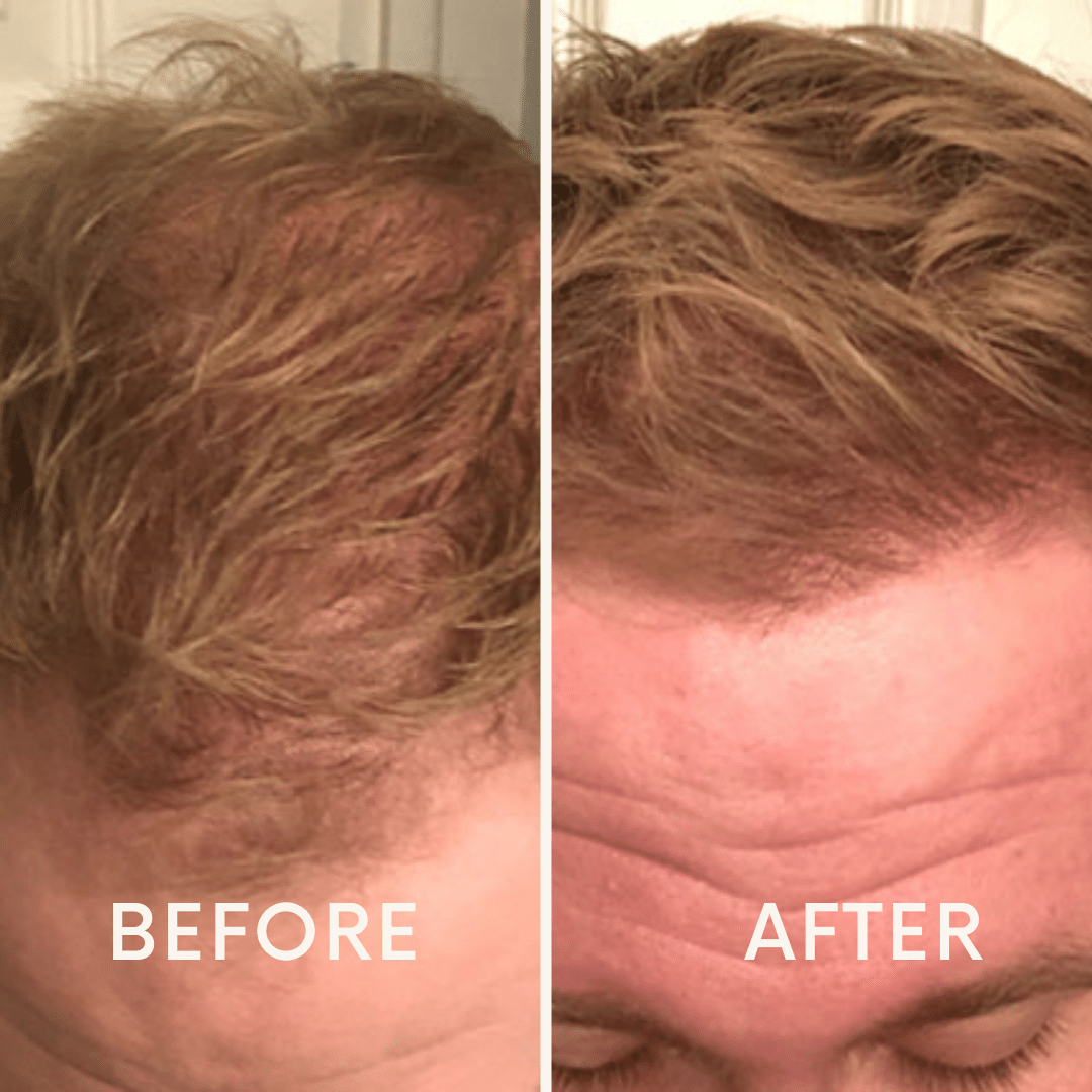 🔥Seurico™ Patented🔥 Red Light Therapy Hair Growth Cap