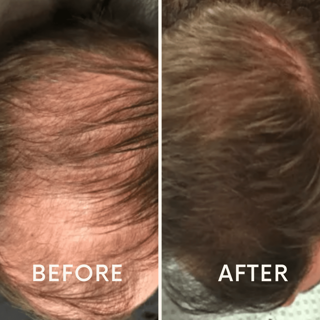 🔥Seurico™ Patented🔥 Red Light Therapy Hair Growth Cap