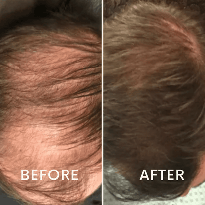 🔥Seurico™ Patented🔥 Red Light Therapy Hair Growth Cap