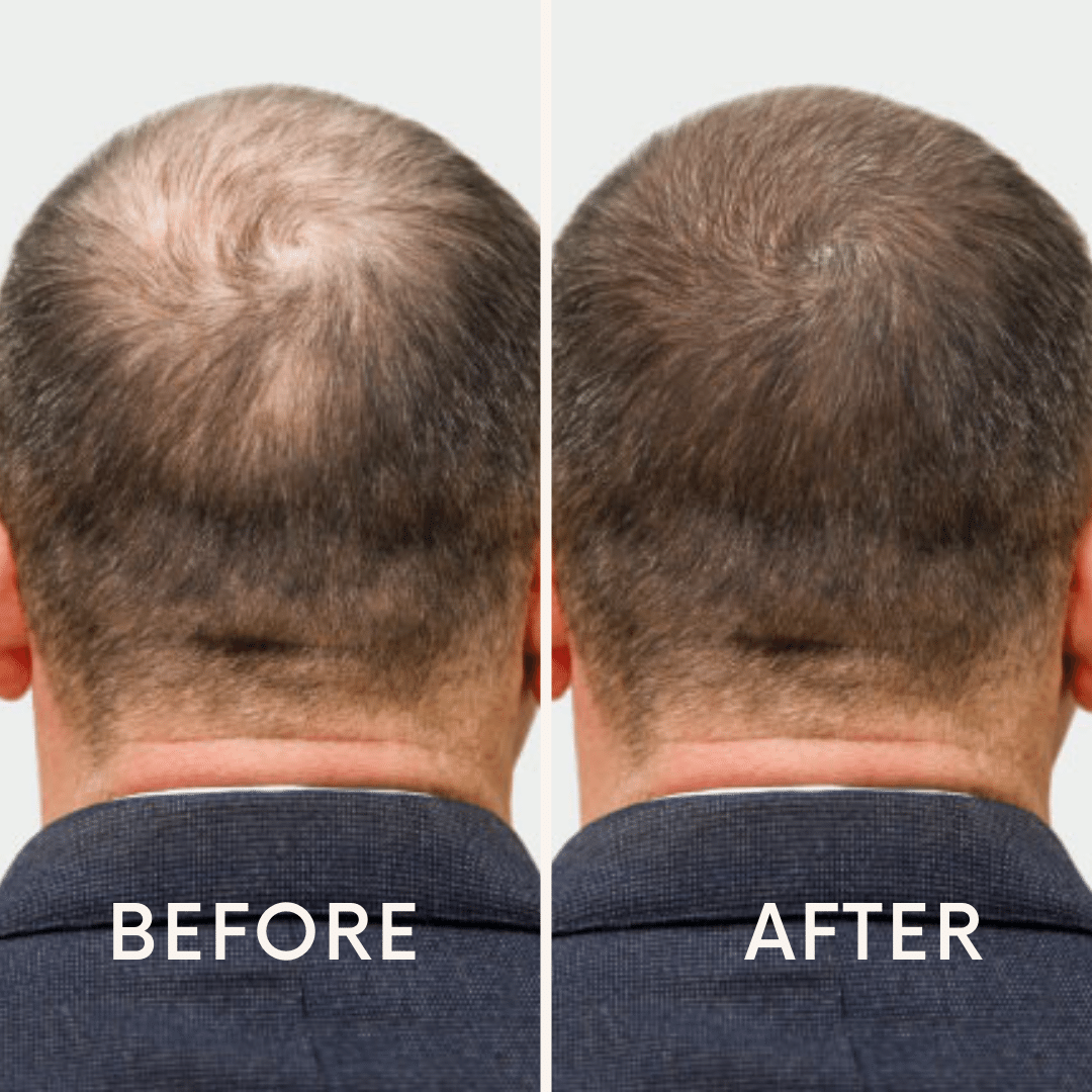 🔥Seurico™ Patented🔥 Red Light Therapy Hair Growth Cap