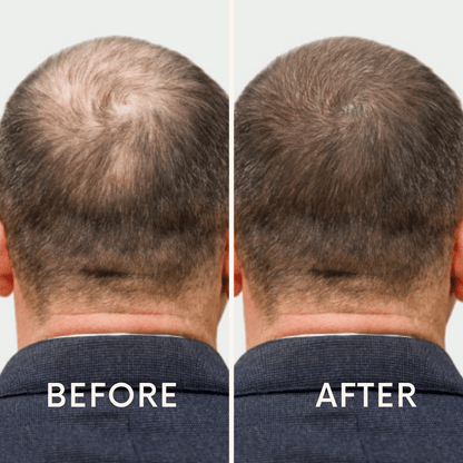 🔥Seurico™ Patented🔥 Red Light Therapy Hair Growth Cap