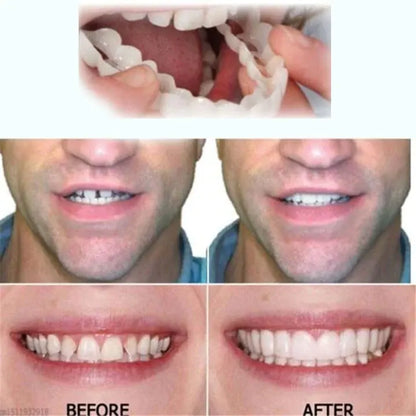 💝Last day discount-75%Off💝Latest👨‍⚕Adjustable Snap-On Dentures😁